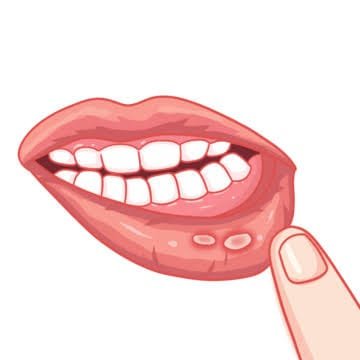 Mouth Ulcers: Causes and Management.